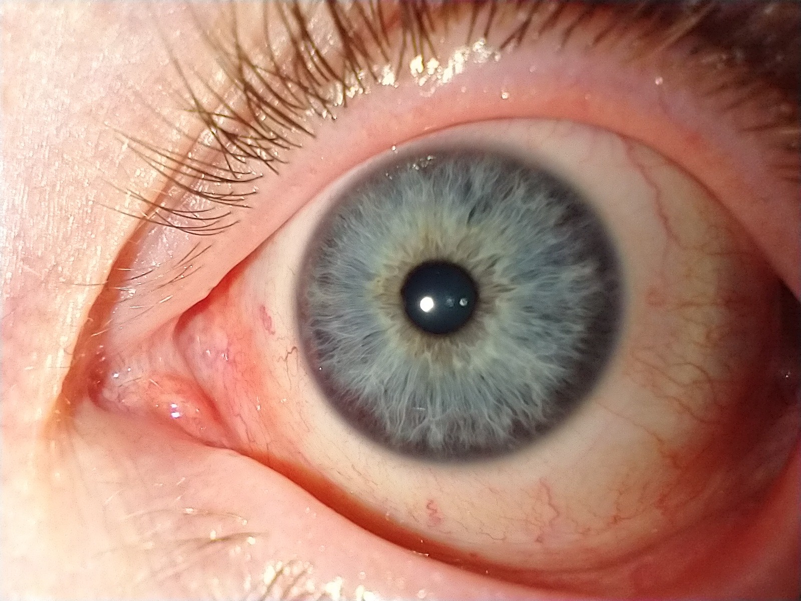 what-is-iridology